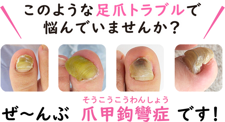 このような足爪トラブルで悩んでいませんか？ぜーんぶ爪甲鉤彎症（そうこうこうわんしょう）です。